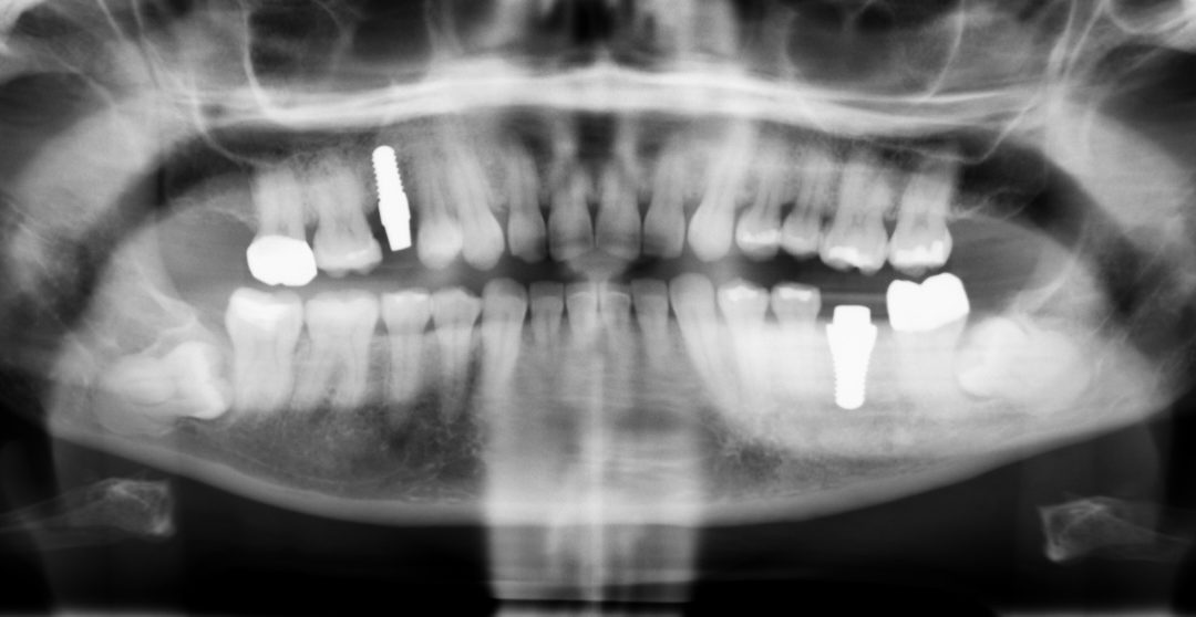 Dental Implants, Trigeminal Neuralgia, and Chronic Pain